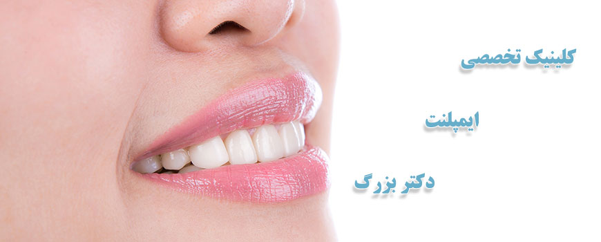 ایمپلنت دندان